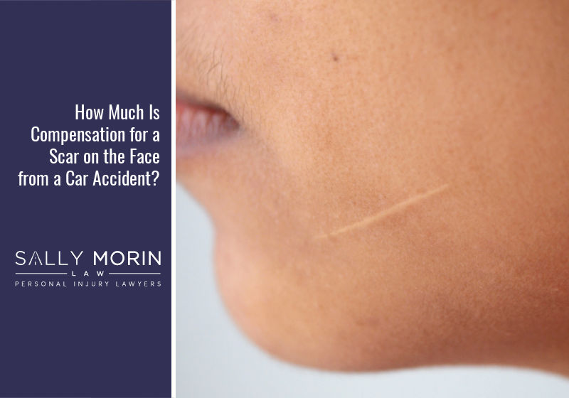 How Much Is Compensation for a Scar on the Face from a Car Accident?